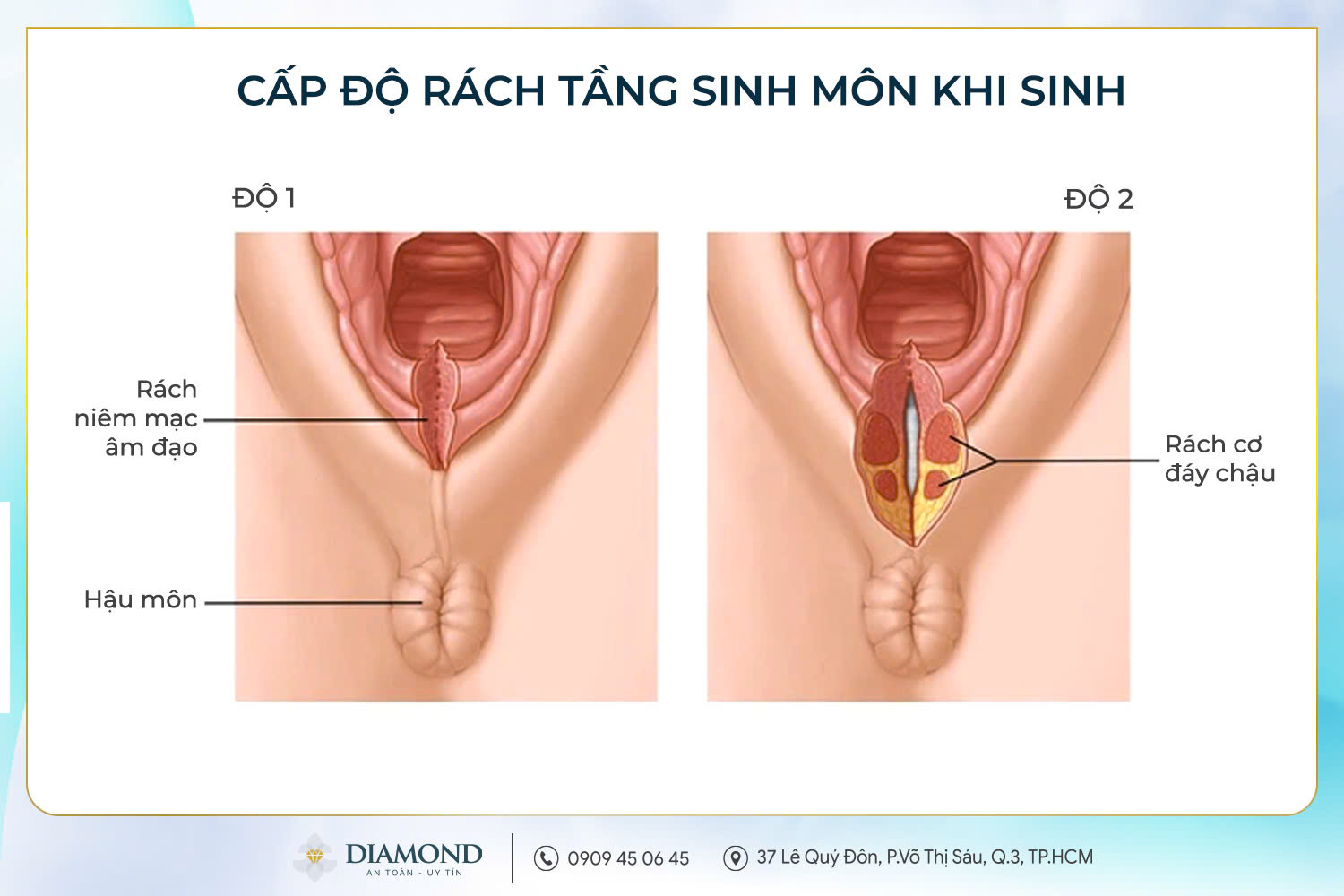 Rách tầng sinh môn cấp độ 1 và 2
