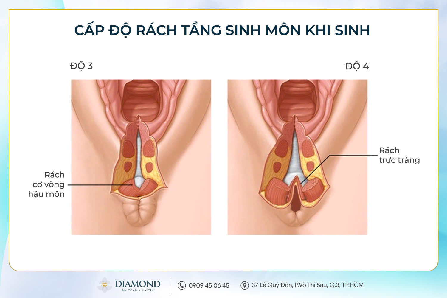 Rách tầng sinh môn cấp độ 3 và 4