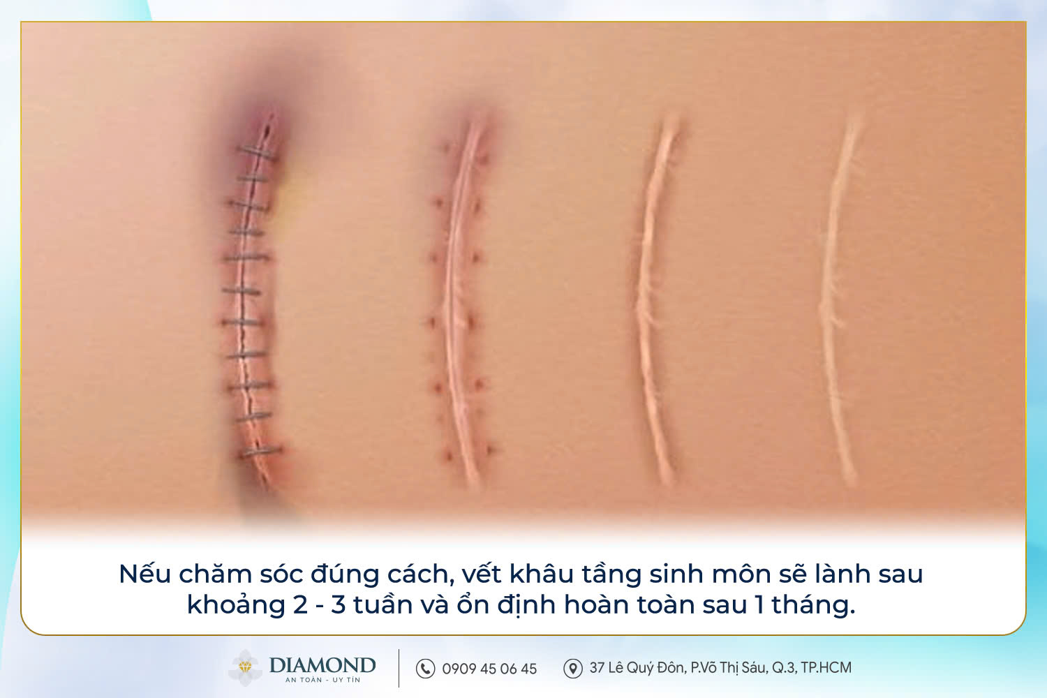 Chăm sóc tầng sinh môn sau sinh