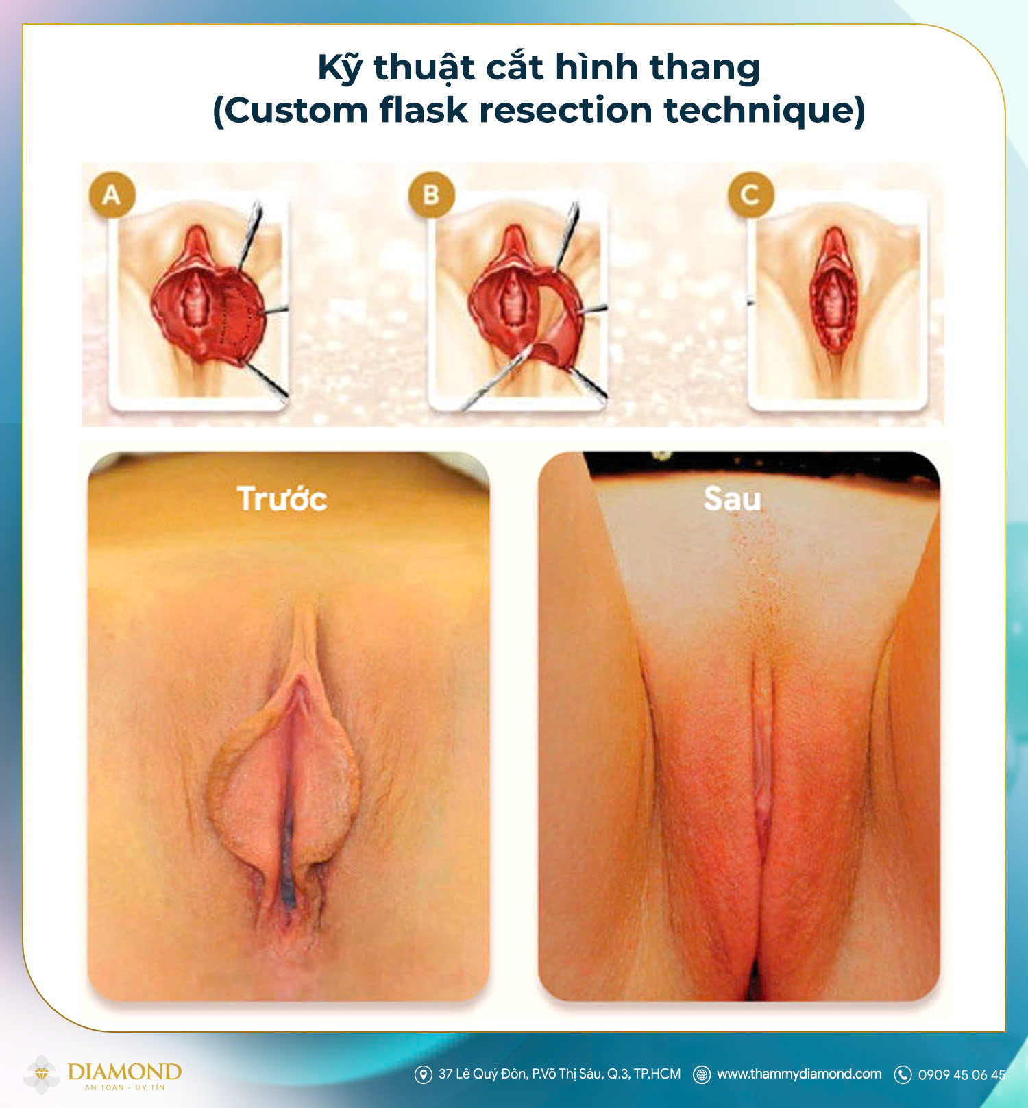 Kỹ thuật cắt hình thang