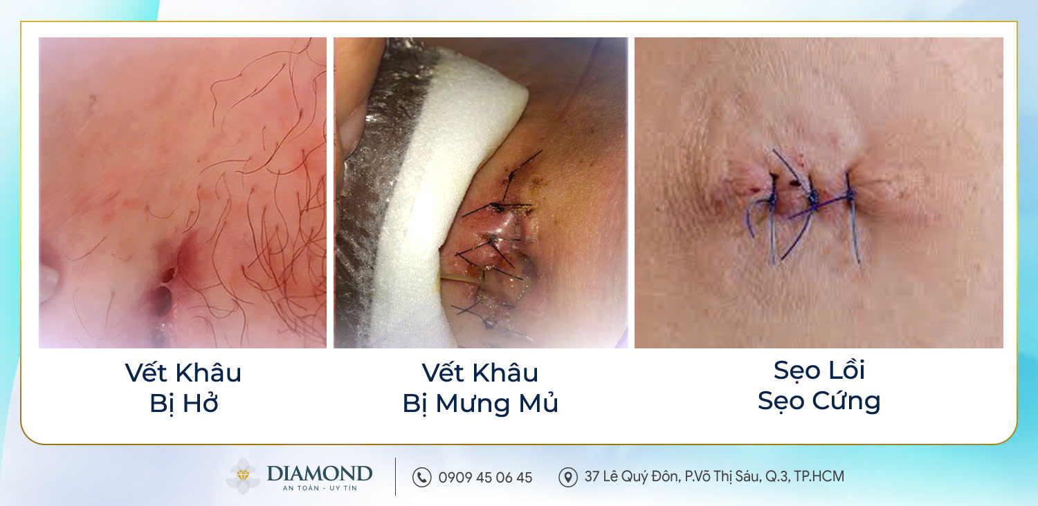 Nguy cơ nhiễm trùng tầng sinh môn