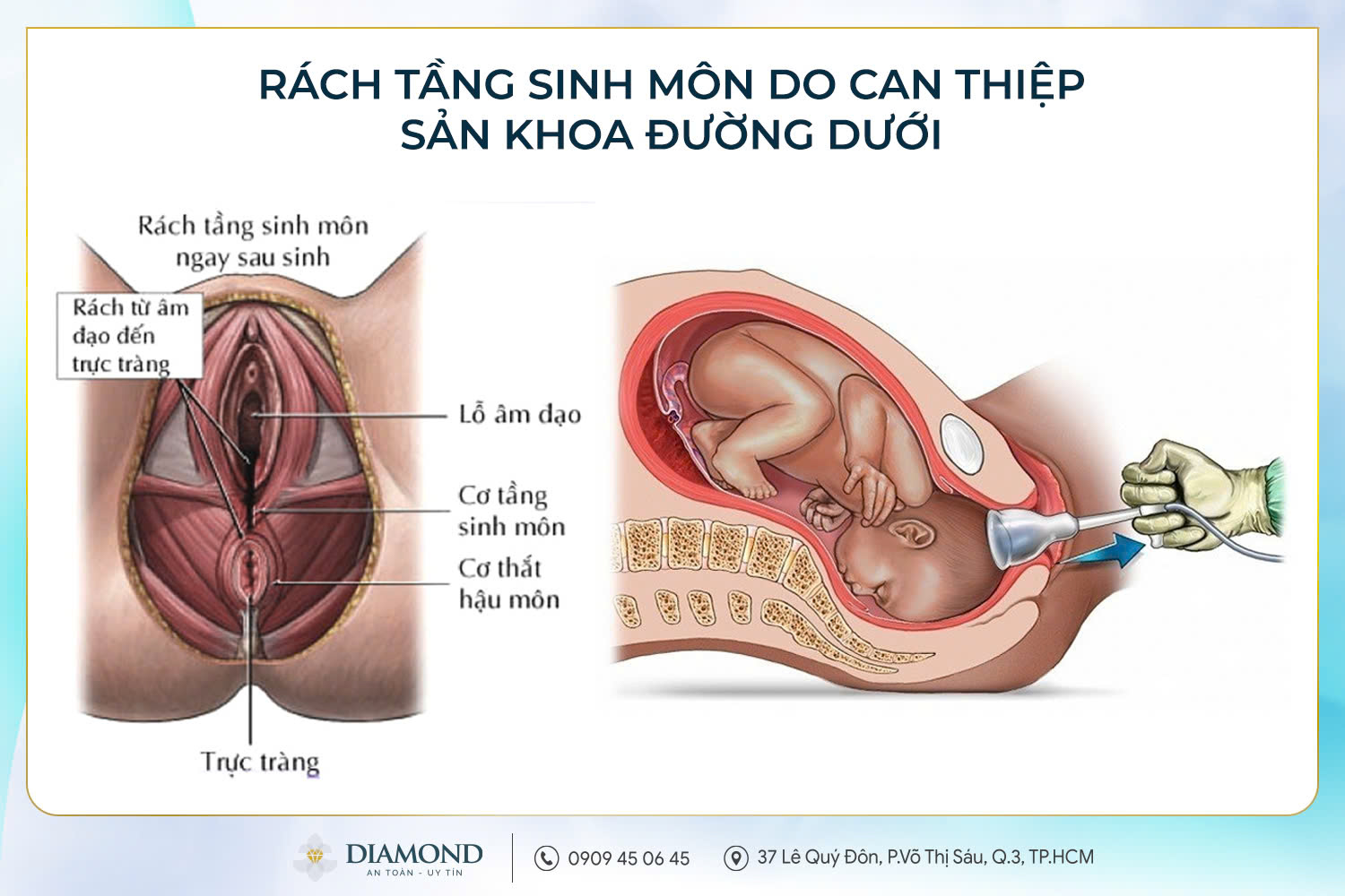 Rách tầng sinh môn do can thiệp sản khoa đường dưới