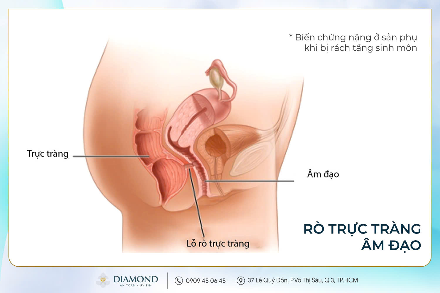 Rò trực tràng âm đạo