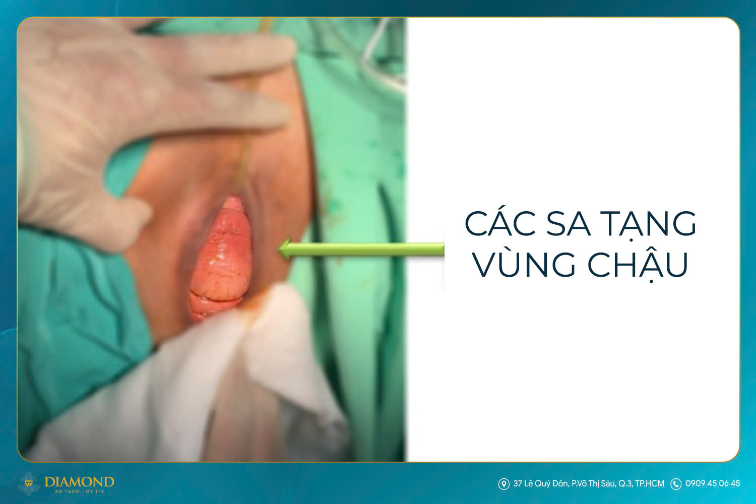 Các sa tạng vùng chậu