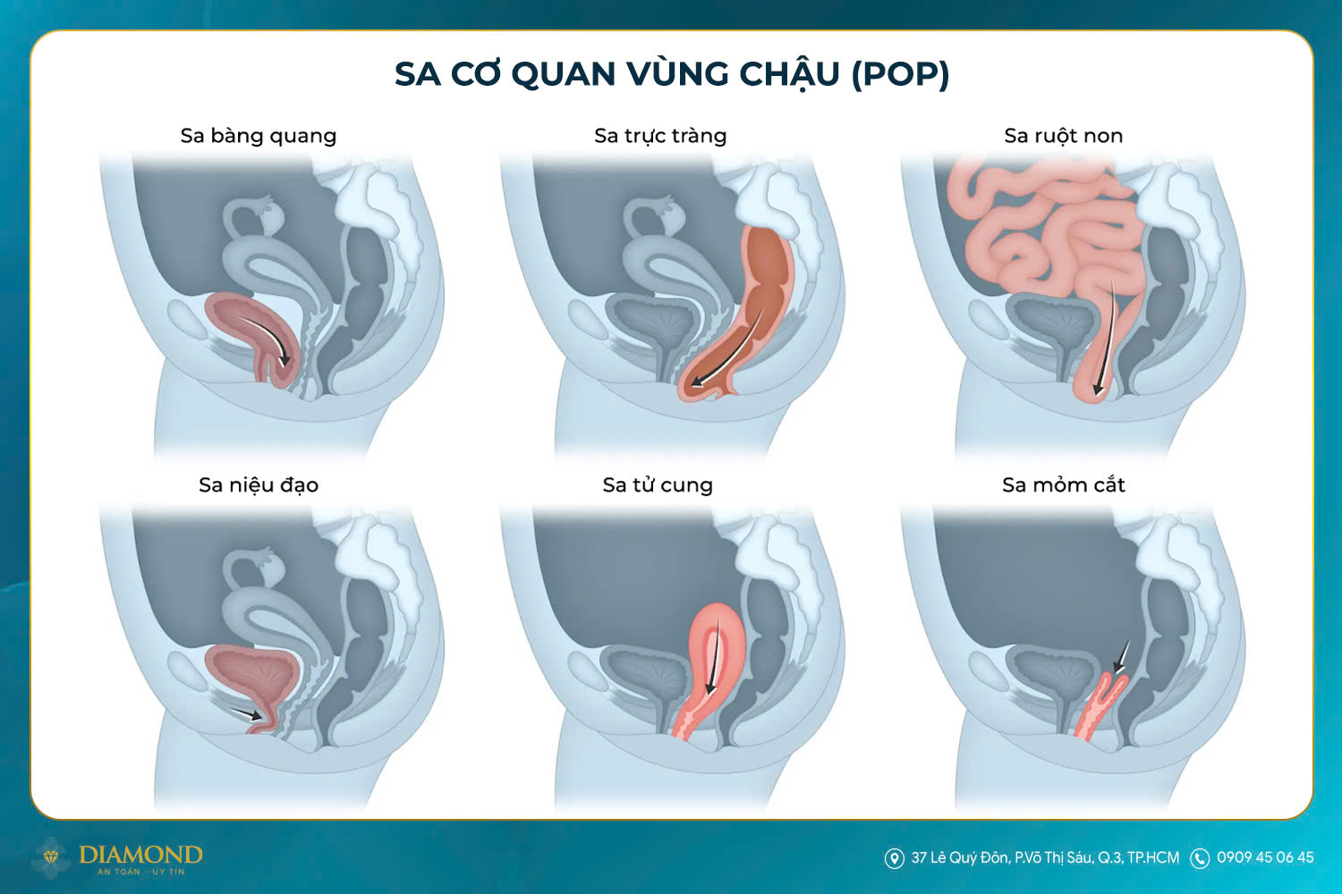 Sa cơ quan vùng chậu (POP)