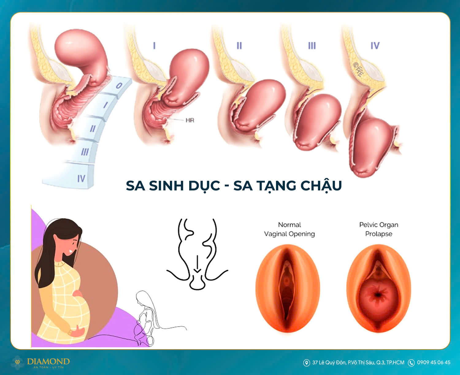 Sa sinh dục - Sa tạng chậu