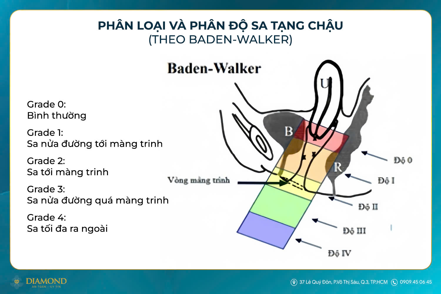 Phân loại và phân độ sa tạng chậu (Theo Baden Walker)
