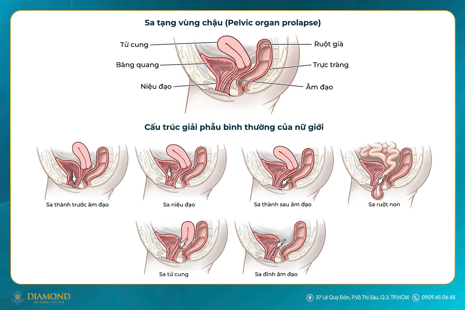 Sa tạng vùng chậu