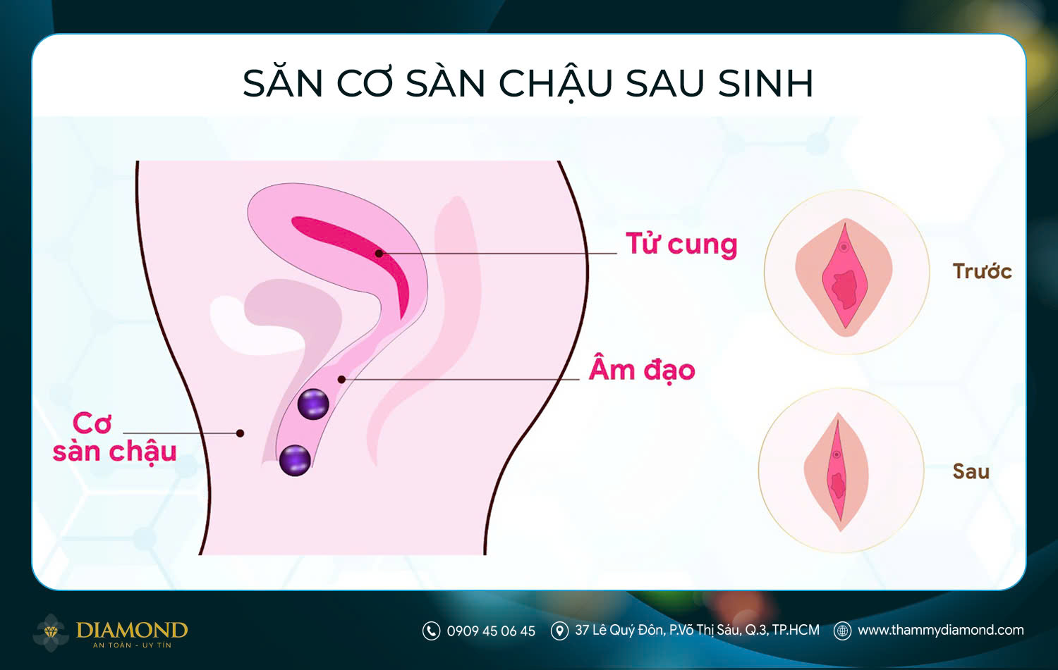 Săn cơ sàn chậu sau sinh